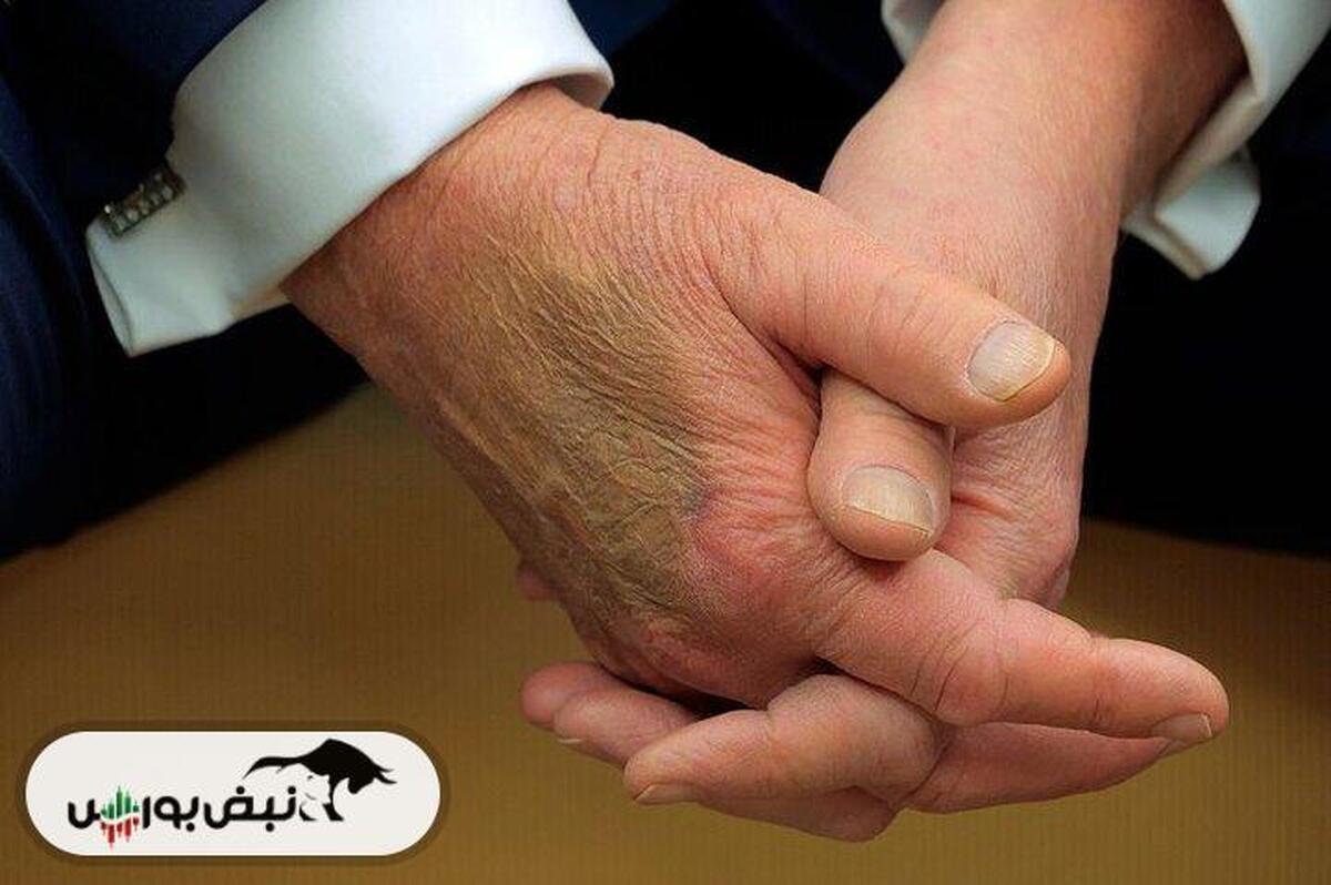 بیماری مرموز دونالد ترامپ فاش شد | چرا ترامپ دیگر نمی‌تواند بند کفشش را ببندد؟