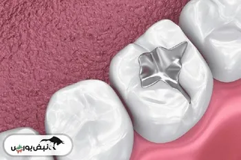 تولید روکش سرامیکی تاج دندان در کشور