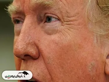 بیماری مرموز ترامپ چیست؟ | چرا ترامپ دیگر نمی‌تواند بند کفشش را ببندد؟