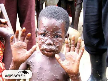 همه چیز درباره بیماری آبله میمونی | علائم آبله میمونی چیست؟